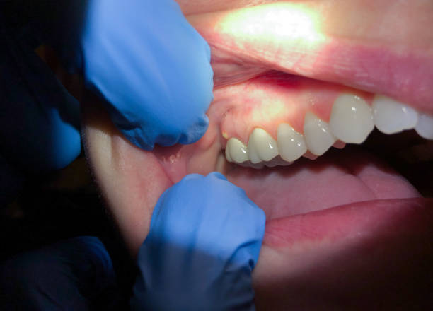 Best Emergency Dentist for Knocked-Out Tooth in Sturgeon, MO