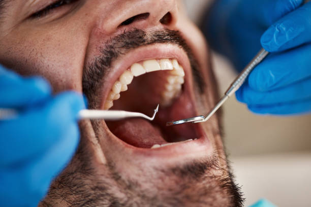Best Emergency Dental Extractions in Sturgeon, MO