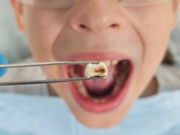 Best Emergency Dental Care for Abscessed Tooth in Sturgeon, MO