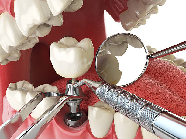 Best Emergency Root Canal Treatment in Sturgeon, MO